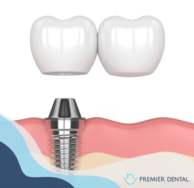 Trồng răng implant là gì