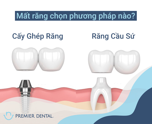 Làm răng ở đâu khi răng bị mất