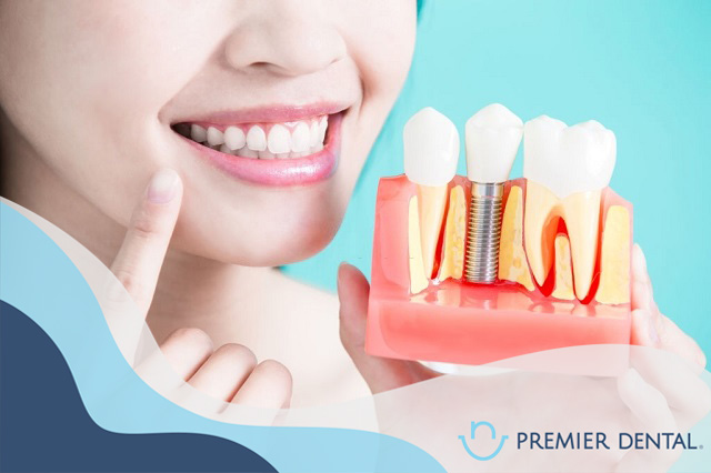 Trồng răng implant có tốt không