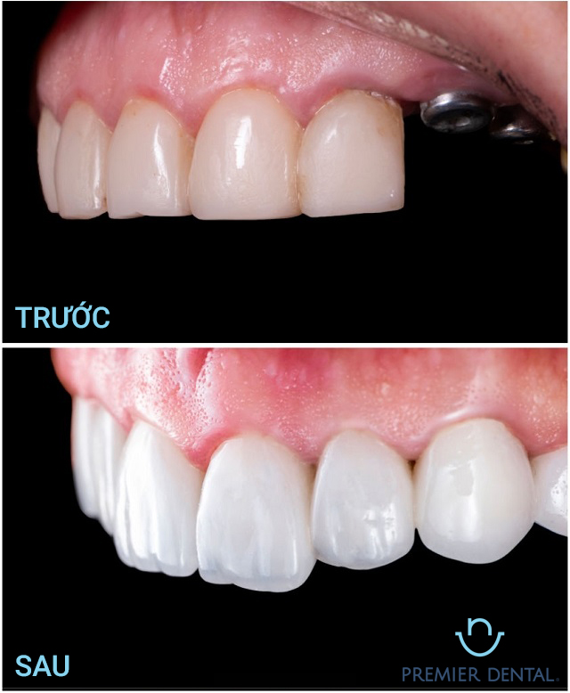 Sau khi trồng implant sẽ như thế nào