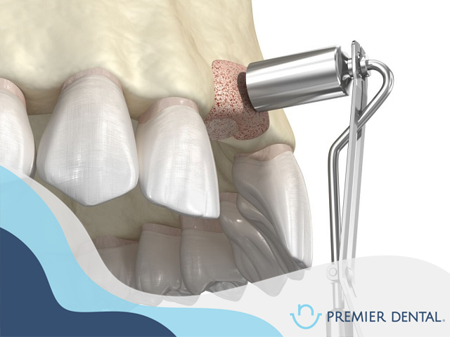 Trồng răng implant khi bị tiêu xương