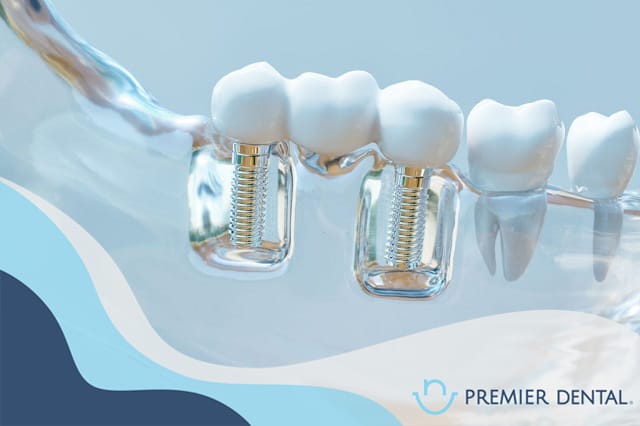 Trồng răng implant là gì