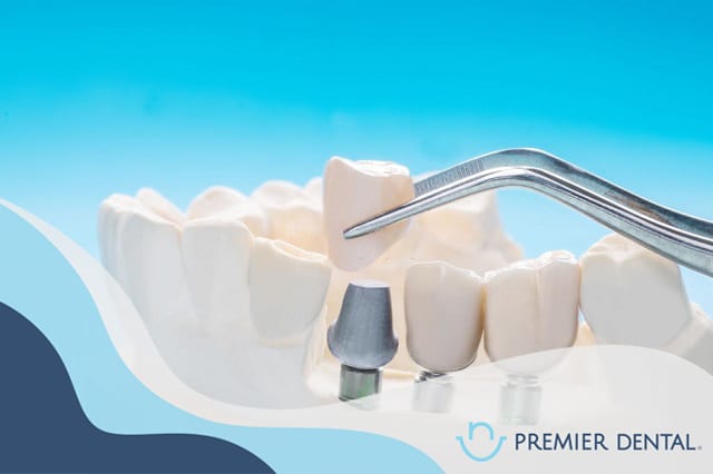 Trồng răng implant có mất thời gian không