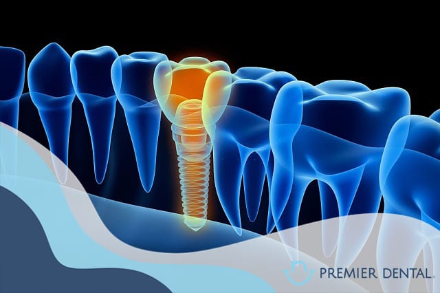 Trồng răng implant có bền không
