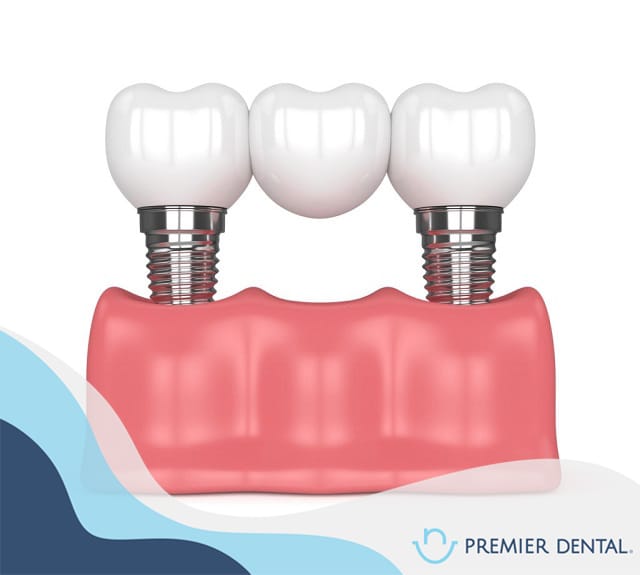 Cấu tạo 3D của trụ implant