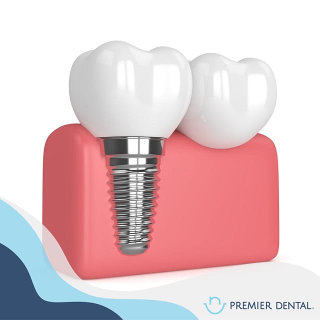 Trồng răng implant không đau