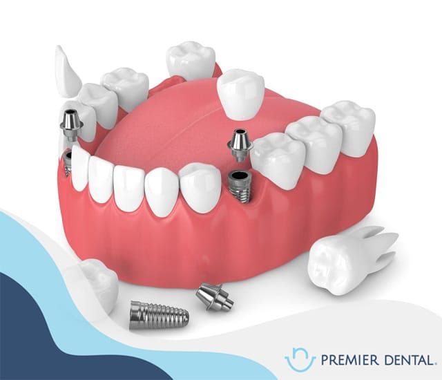 Trồng răng implant ở đâu bền