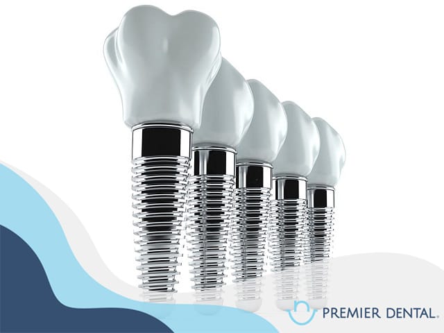 Trồng răng implant có tốt không