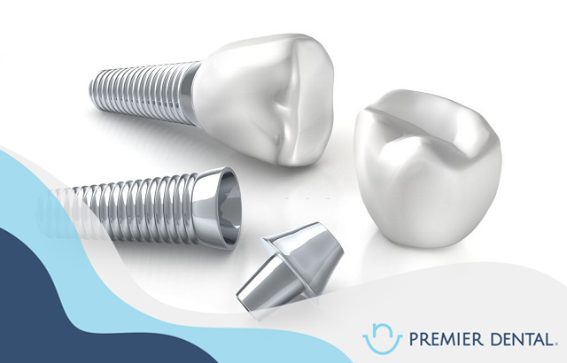 Cấu tạo từng phần của răng implant