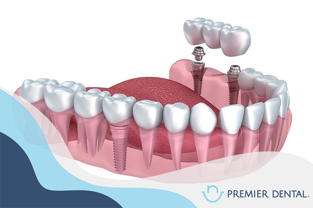 Răng bị mất có nên làm cầu răng sứ không