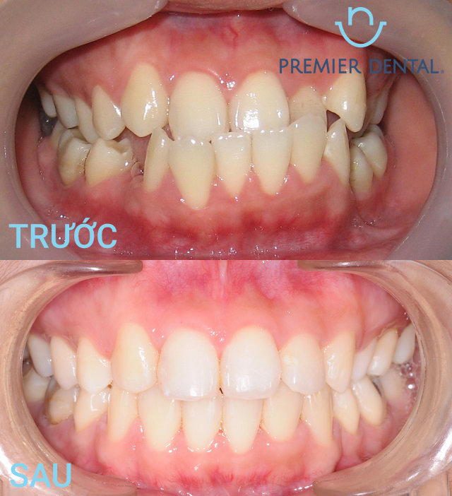 Sau khi niềng răng mắc cài sứ trông sẽ như thế nào
