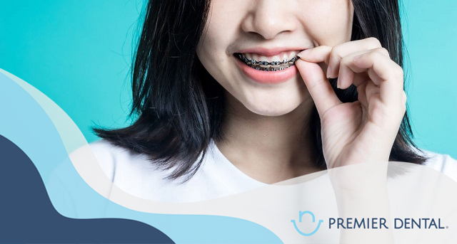 Niềng răng mắc cài kim loại là phương pháp truyền thống để chỉnh nha