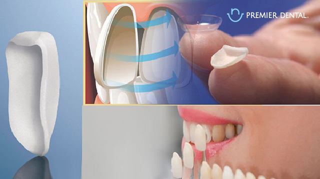 Dán sứ veneers làm trắng răng