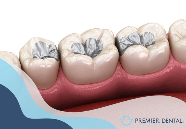 Mô phỏng vật liệu trám răng bằng Amalgan