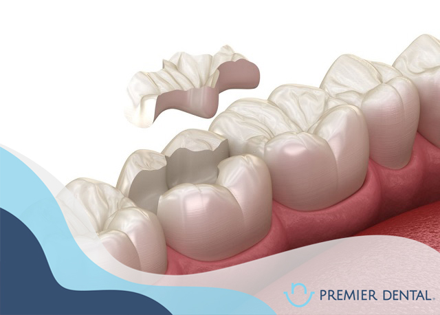 Mô phỏng vật liệu trám răng bằng sứ