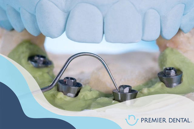 Răng implant xuất xứ ở đâu