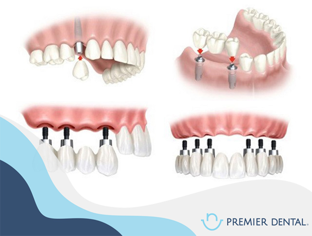 Răng bị mất có nên cấy ghép răng không