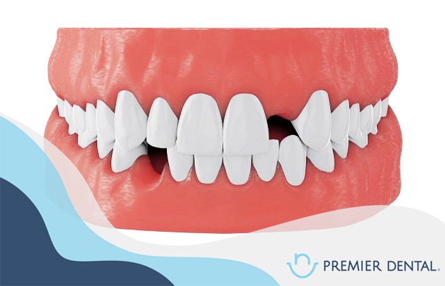 Nhổ răng hàm không trồng lại có bị gì không