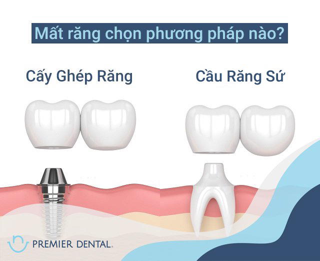 Cầu răng sứ hay trồng răng implant tốt hơn?
